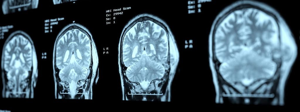 Legal Options For People With Brain Injuries in Toronto